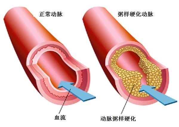 動脈硬化大百科：動脈粥樣硬化的發(fā)生機(jī)制
